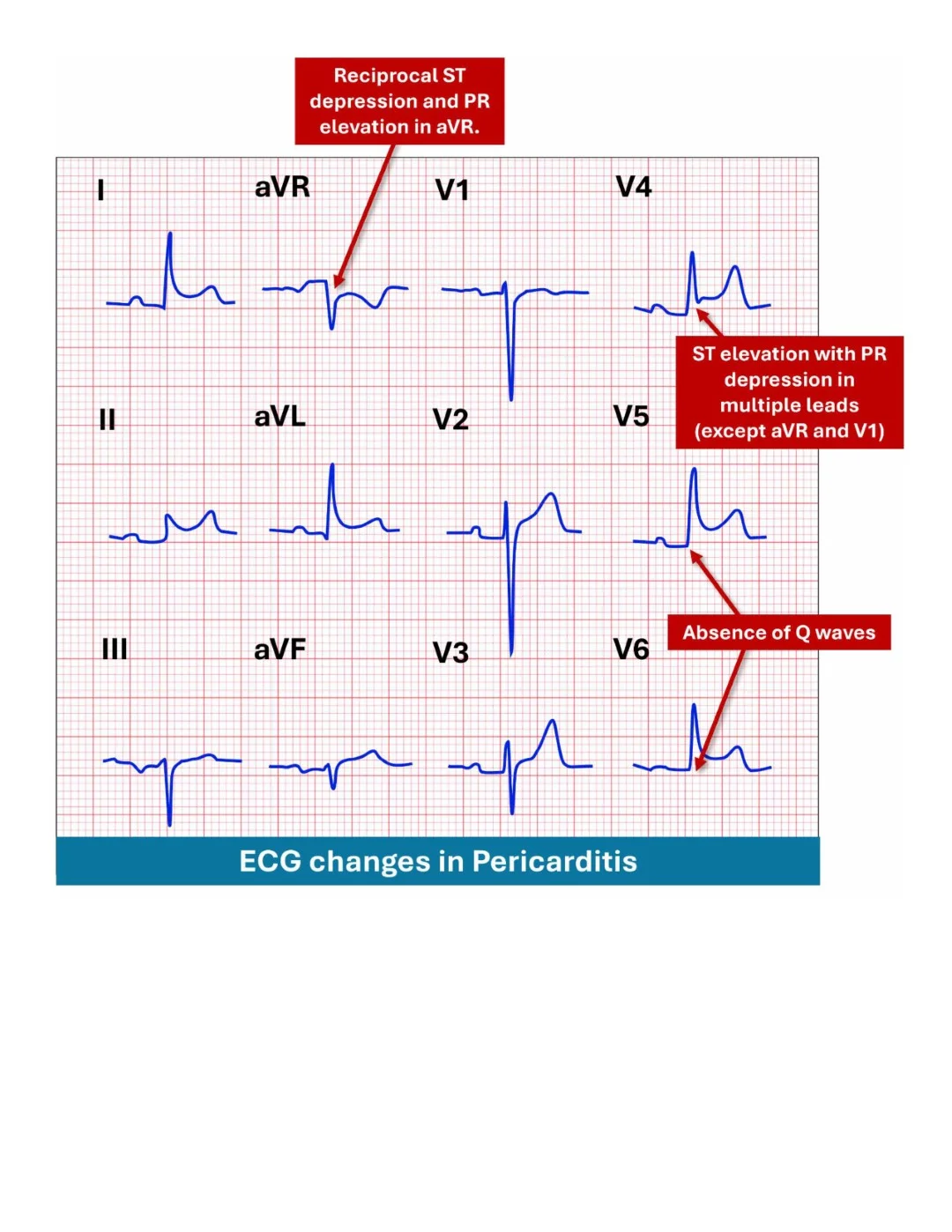 Cambridge ECG Simplified Made Easy Sample images (16)
