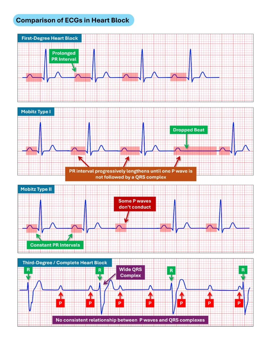 Cambridge ECG Simplified Made Easy Sample images (4)